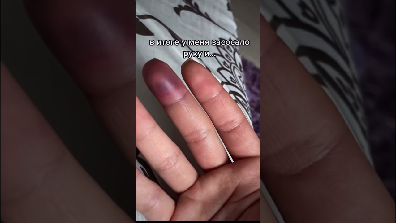 сломала палец