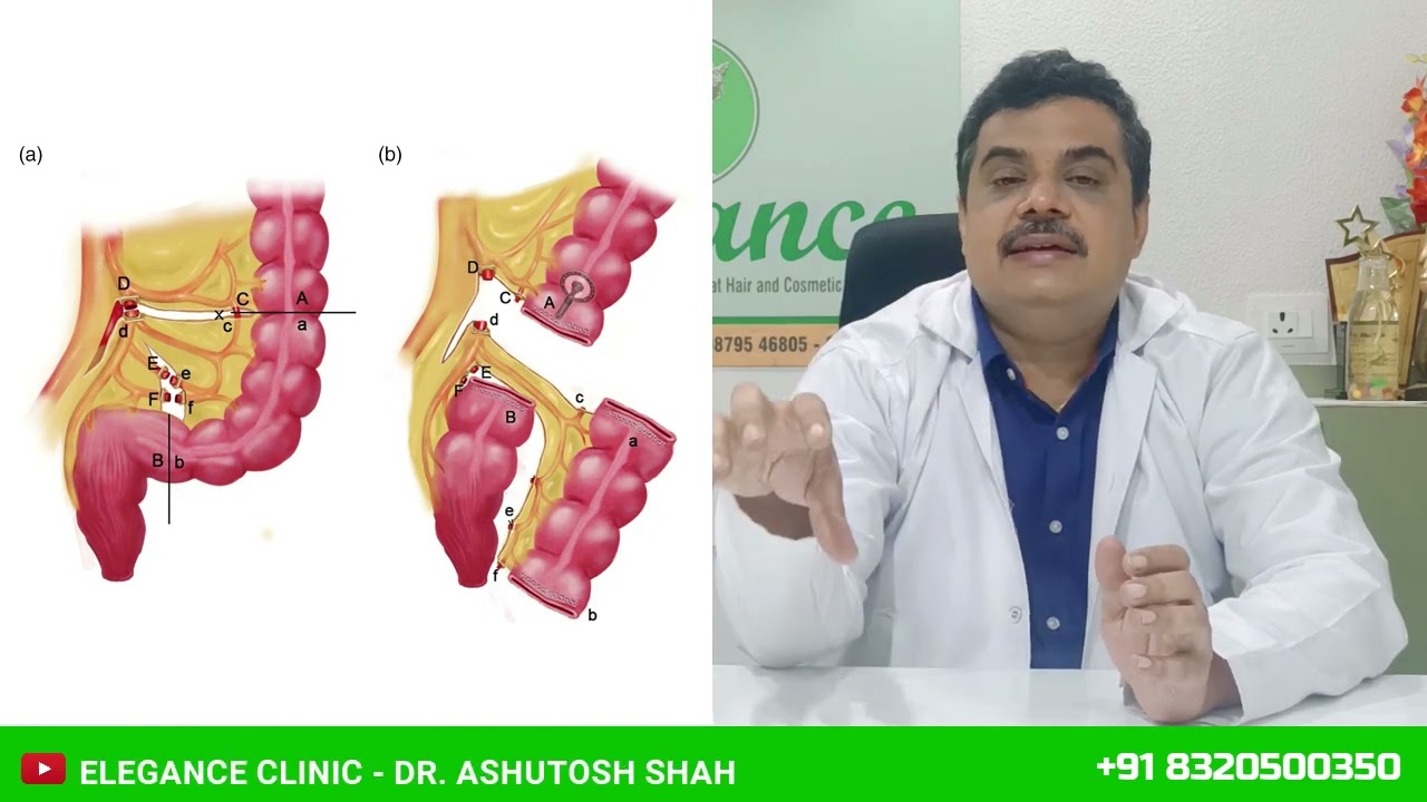 Sigmoid Vaginoplasty Surgery  Male to Female Vagina Treatment in Ankleshwar, Anand, Mumbai, Surat