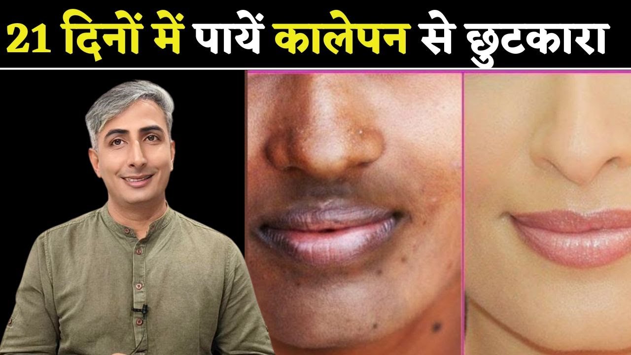 मुँह के चारों ओर कालापन को दूर करने के लिए उपचार I HOW TO GET FAIR SKIN I DR. MANOJ DAS
