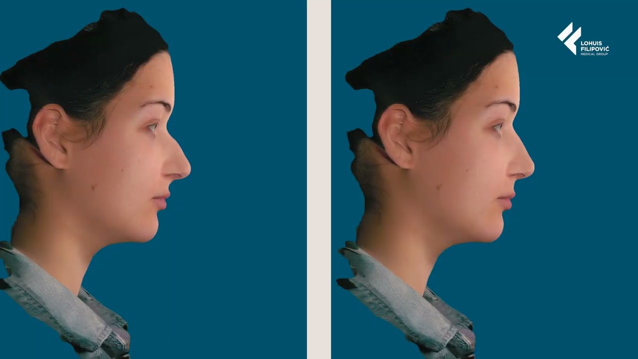 &Scaron;to je Vectra 3D? Otkrijte svoj izgled nakon estetskih zahvata