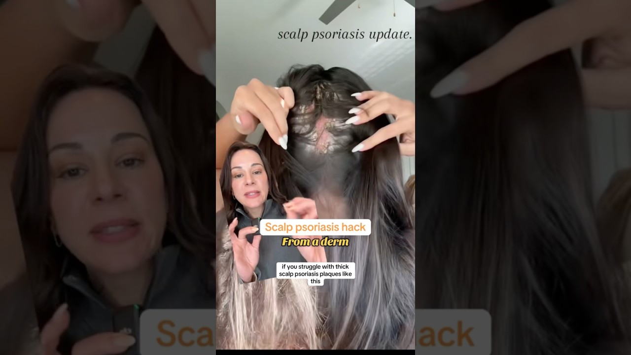 Scalp Psoriasis HACK — From A Derm | #shorts #skincare |
