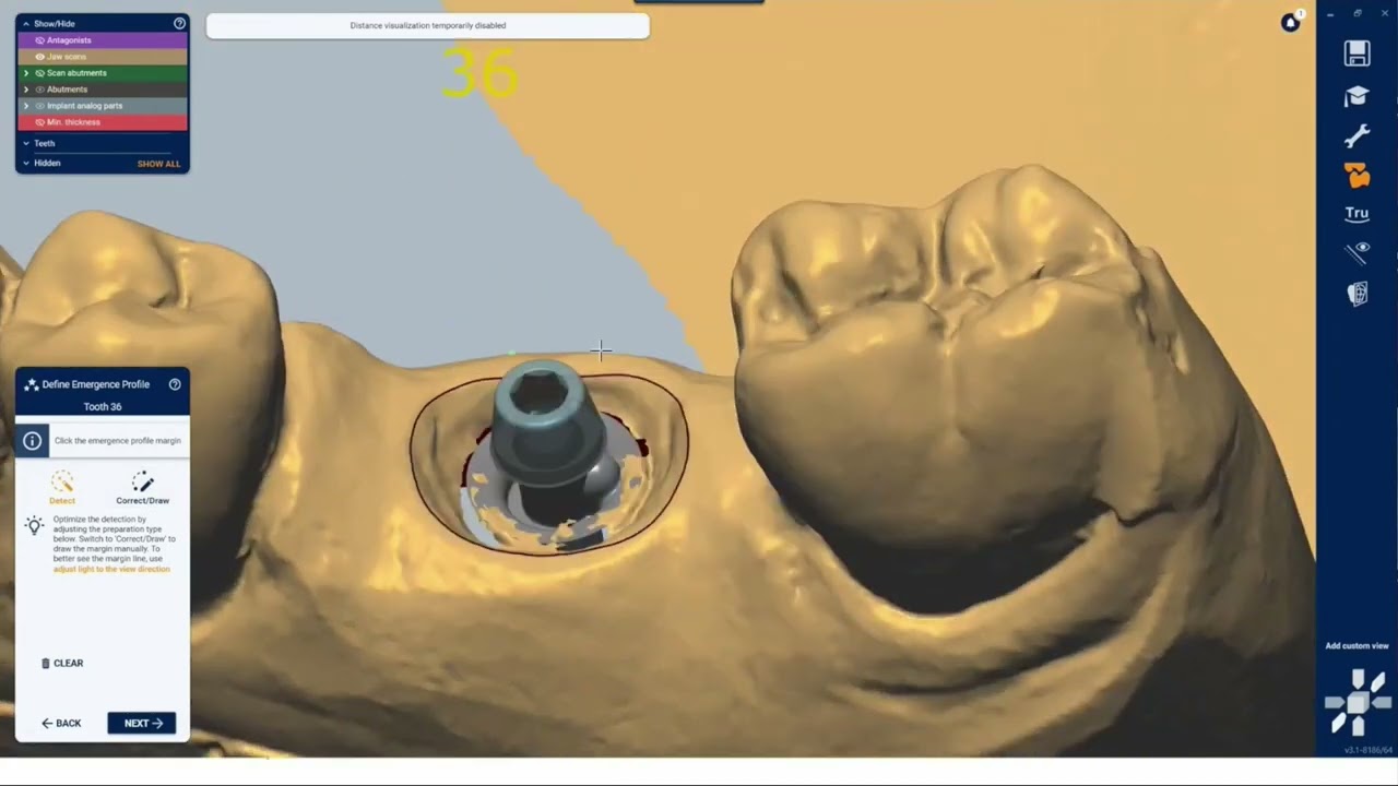 matrix® CAM Amann Girrbach Workflow | matrix® Digital Academy