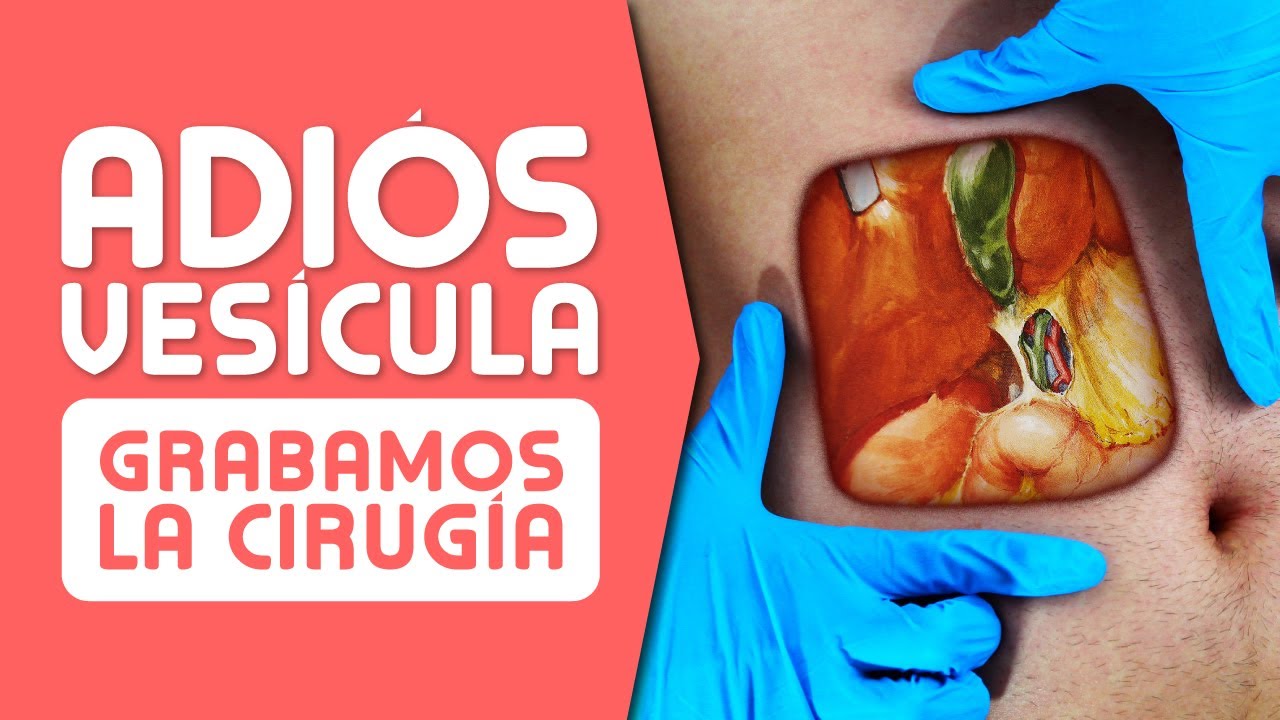 LA VESÍCULA ¿Cuándo es Mejor OPERAR? Síntomas, Cálculos, Pólipos y Cáncer