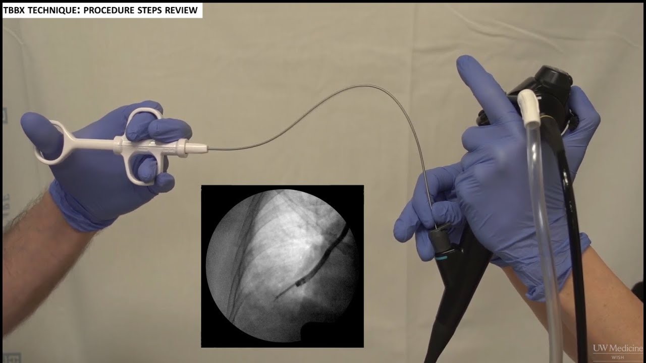 Transbronchial Biopsies -- BAVLS