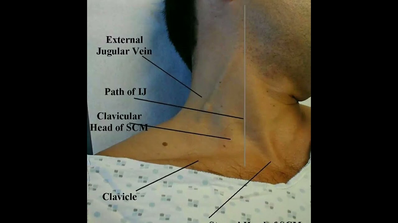 Side of neck spotting External juglar vein Clavicle 