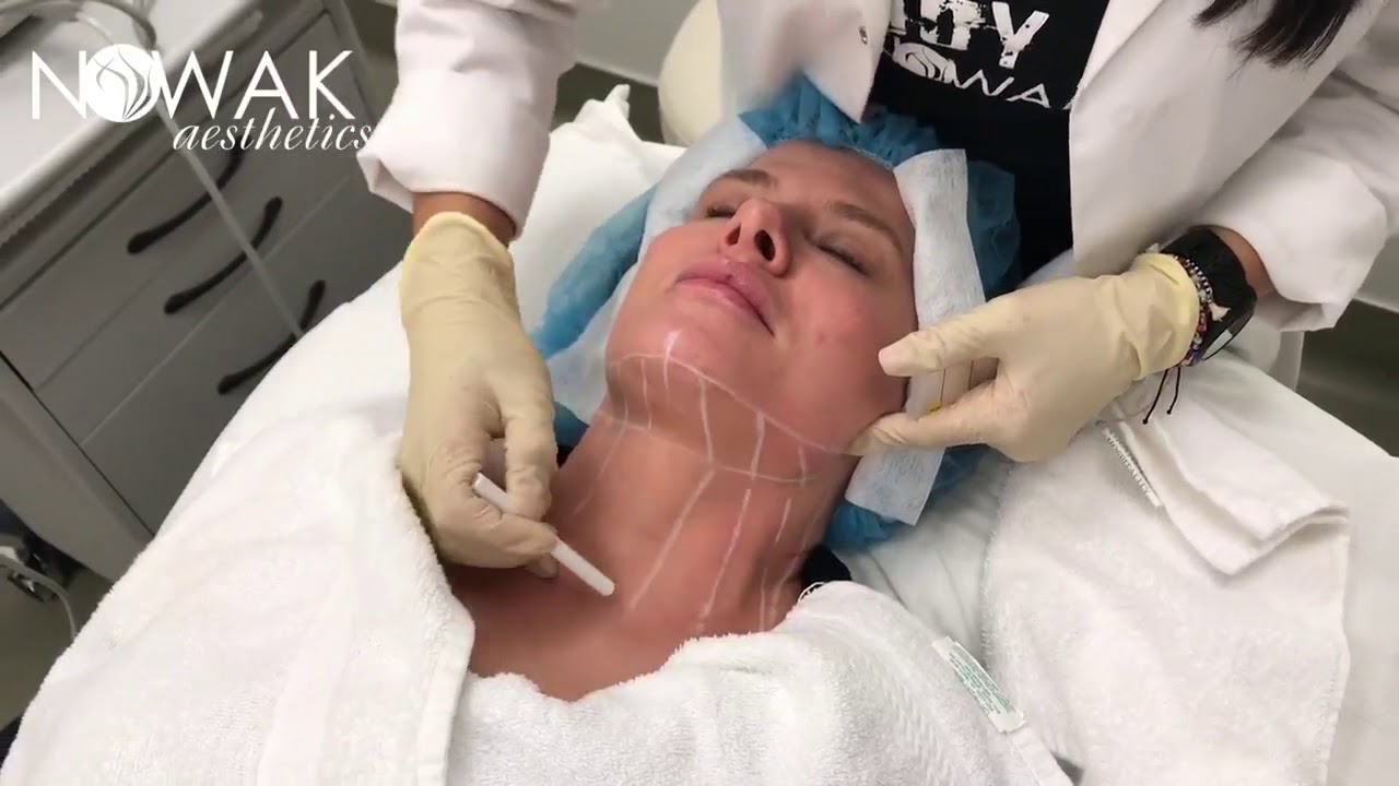 Ultherapy Procedure: Chin Strap & Neck Treatment