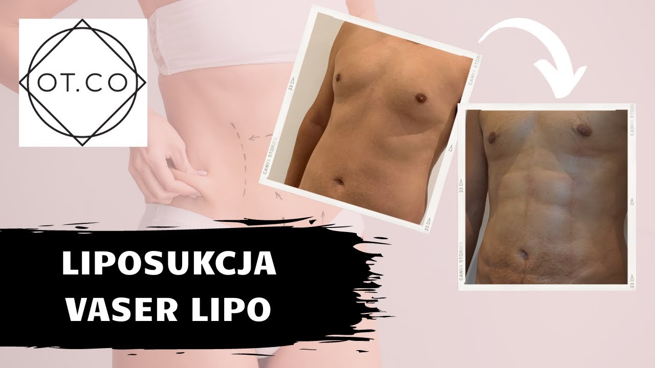 Liposukcja Vaser Lipo, najważniejsze aspekty zabiegu - OT.CO Clinic