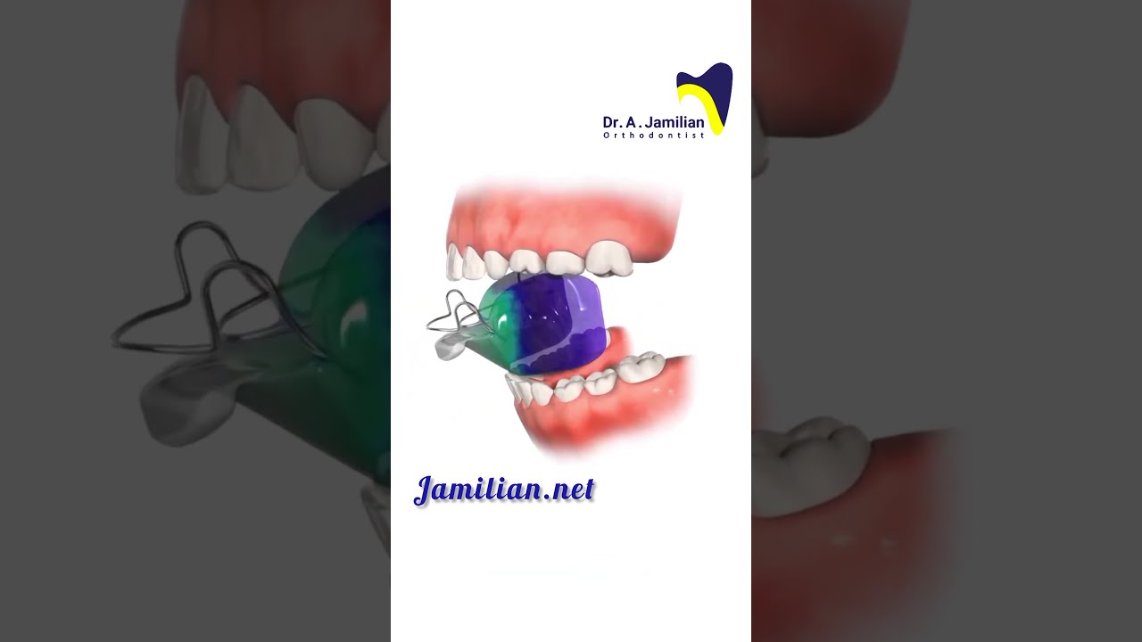 Functional Appliance #dentist #functional  #orthodontics #dental # dentalesthetics #dentaltreatment