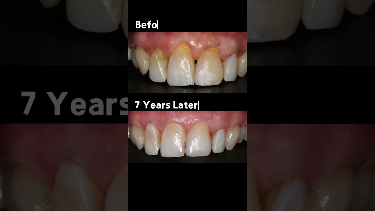 Long-Term Results with the Pinhole&reg; Surgical Technique | 7-Year Follow-Up Case