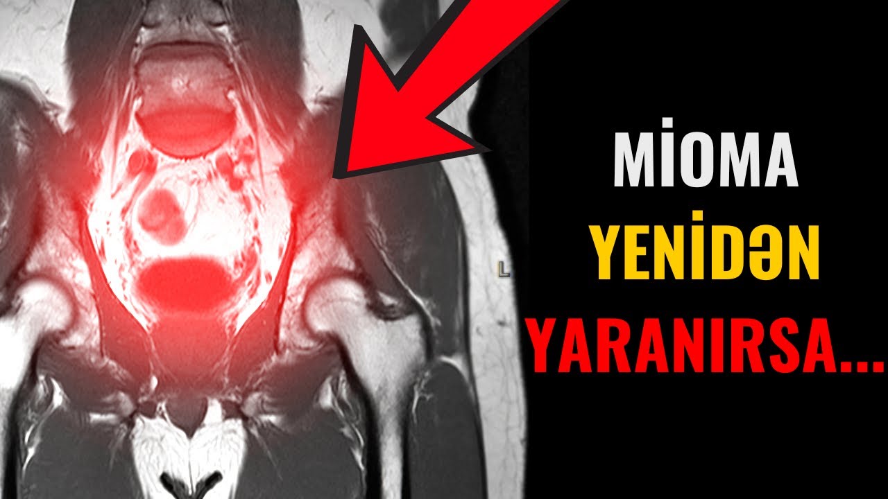 Mioma götürdükdən sonra yenidən yaranmasının səbəbi nədir?