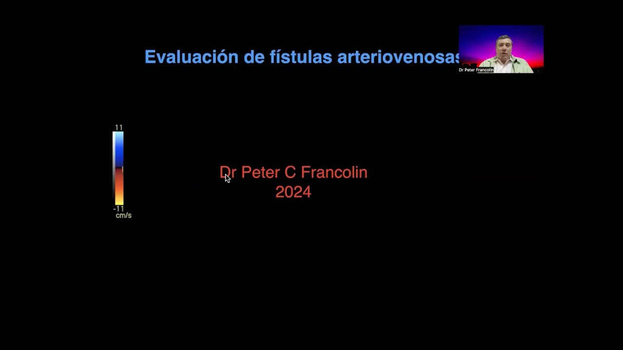 2-13 Investigación de estenosis y complicaciones en fístulas arterio-venosas | Dr. Francolin