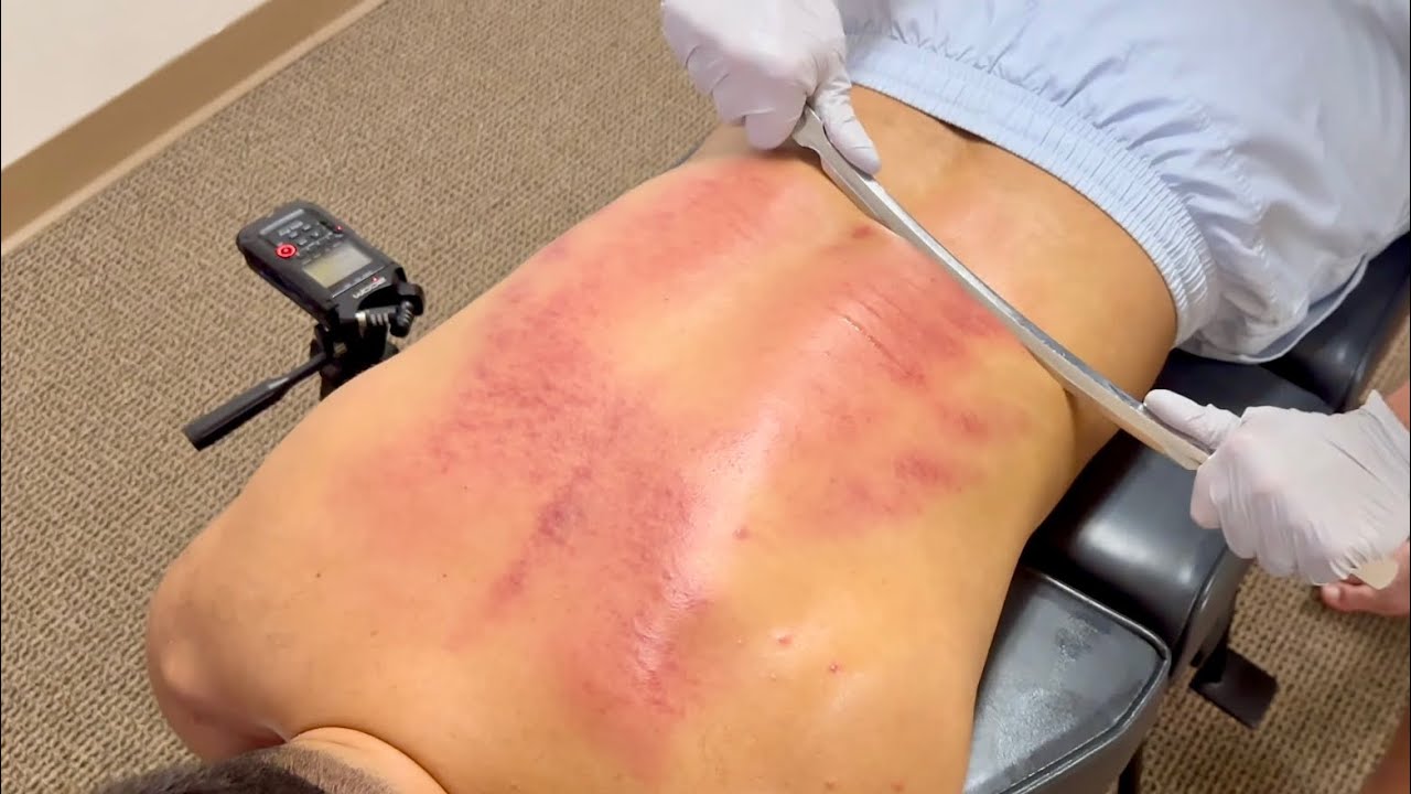 MOTORCYCLE ACCIDENT RECOVERY