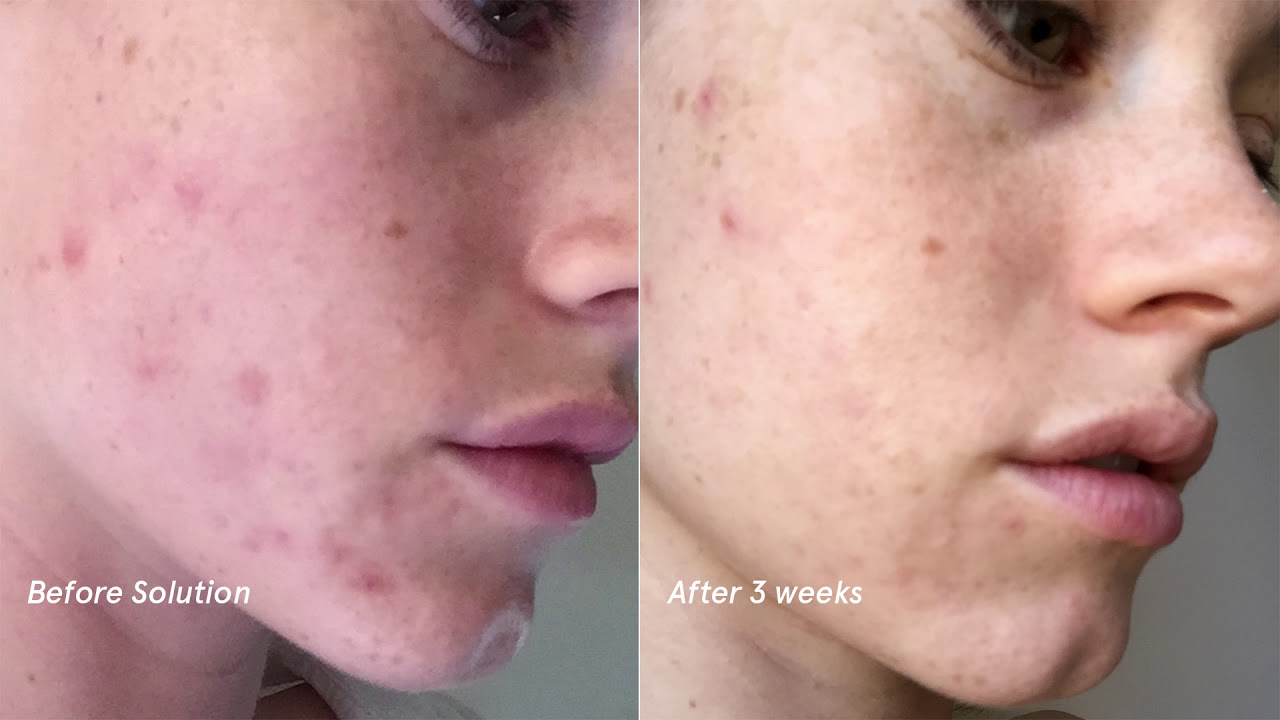 How To Apply Glossier Solution