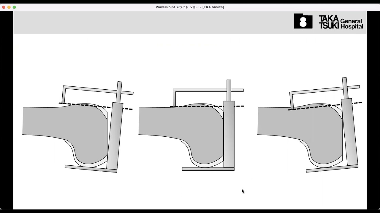 Femoral sizing in TKA (in Japanese)