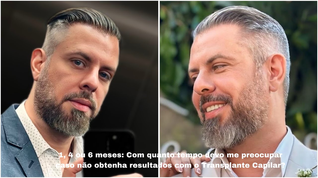 1, 4 ou 6 meses: Quando devo me preocupar caso não obtenha resultados com o Transplante Capilar?