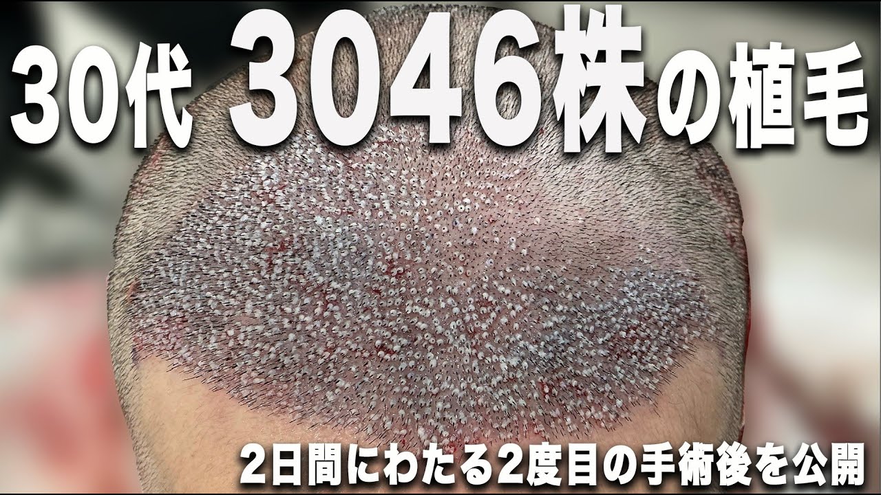 30代のモニター様が3046株の自毛植毛に挑む