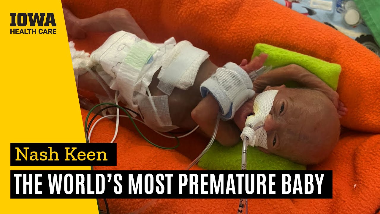 Iowa boy born at 21 weeks is now the world's most premature baby | UI Health Care