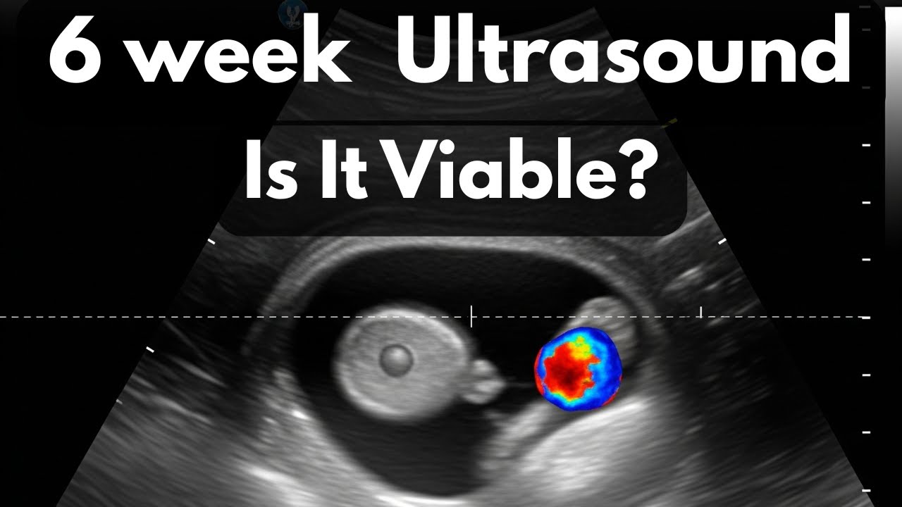 6 Week Pregnancy Ultrasound: Gestational Sac, Yolk Sac, and Fetal Pole Explained