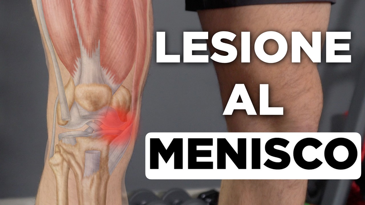 LESIONE e ROTTURA del MENISCO: la GUIDA COMPLETA (cause, esercizi, intervento chirurgico)