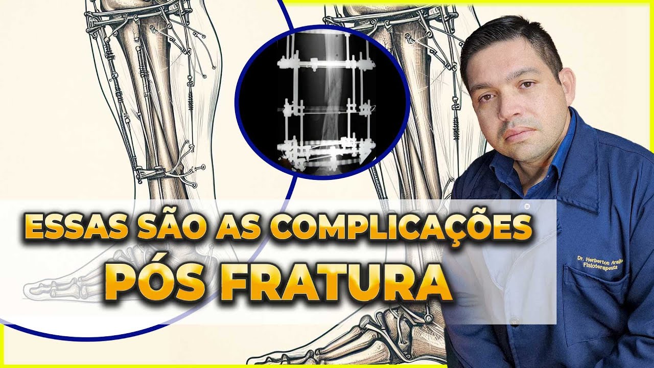 VOCÊ ESTÁ PREPARADO PARA COMPLICAÇÕES APÓS A FRATURA?