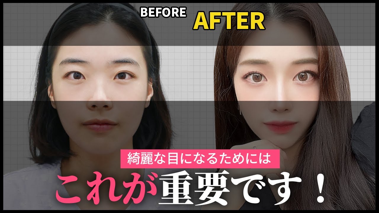 【美容整形】蒙古ひだがあるなら、きれいな目のために目頭切開が必要です！【目整形】