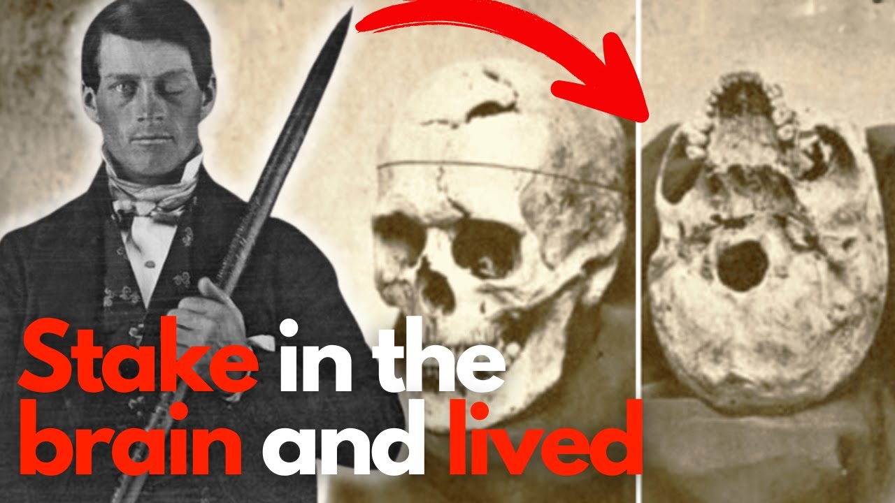 The Phineas Gage Case 🧠💥 | Neuromotricity and the Prefrontal Cortex