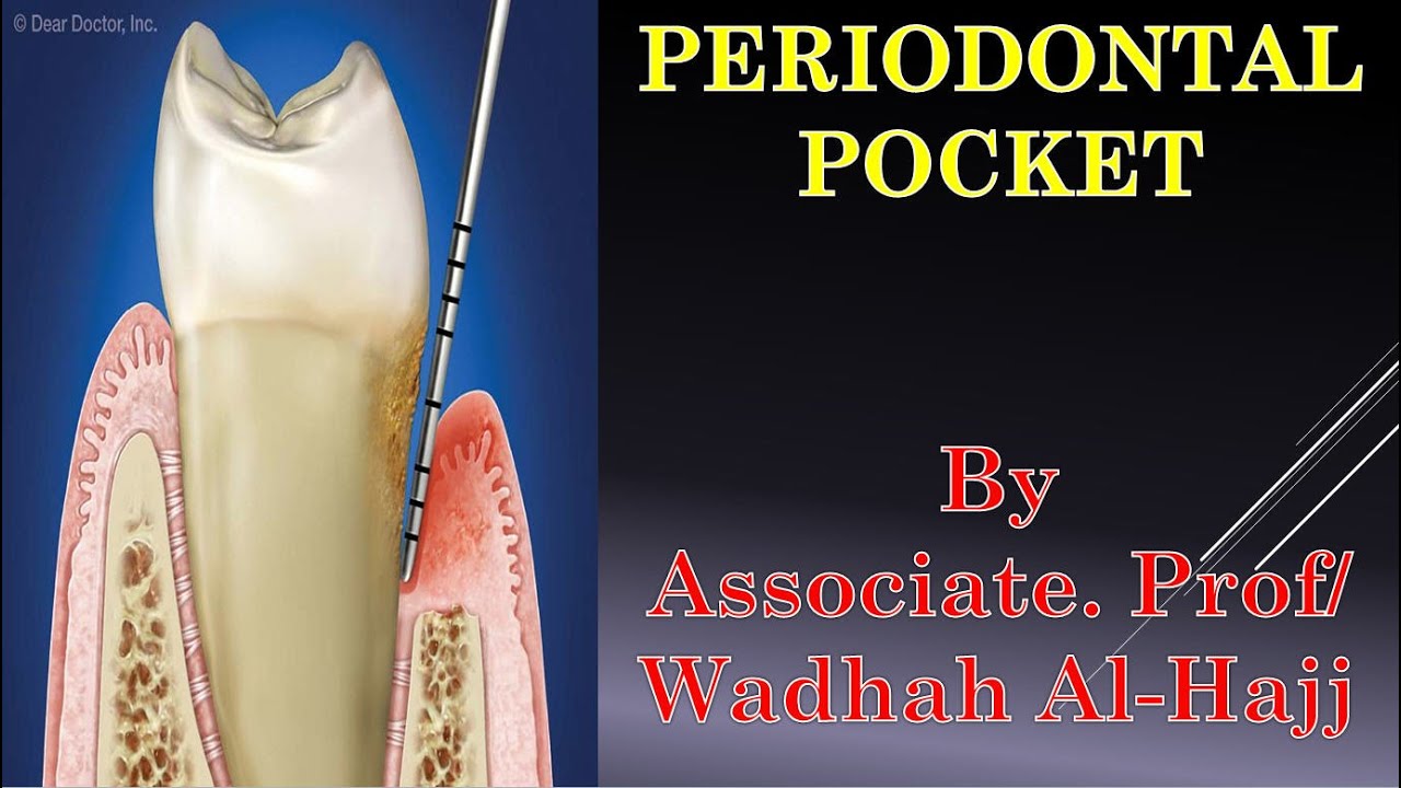 14- Periodontal diseases -4 (Periodontal pockets) - Dr Wadhah Periodontology lectures. د/ وضاح الحاج