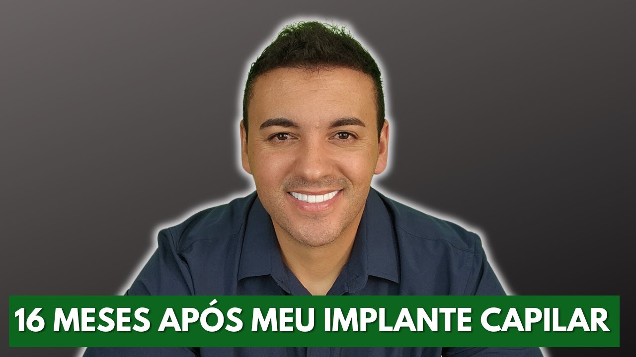 16 MESES APÓS MEU IMPLANTE CAPILAR