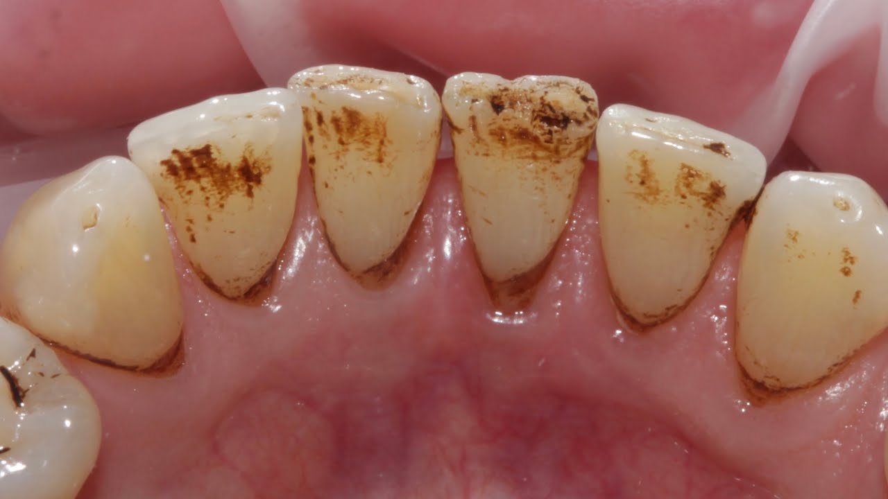 How to prevent tea and coffee staining