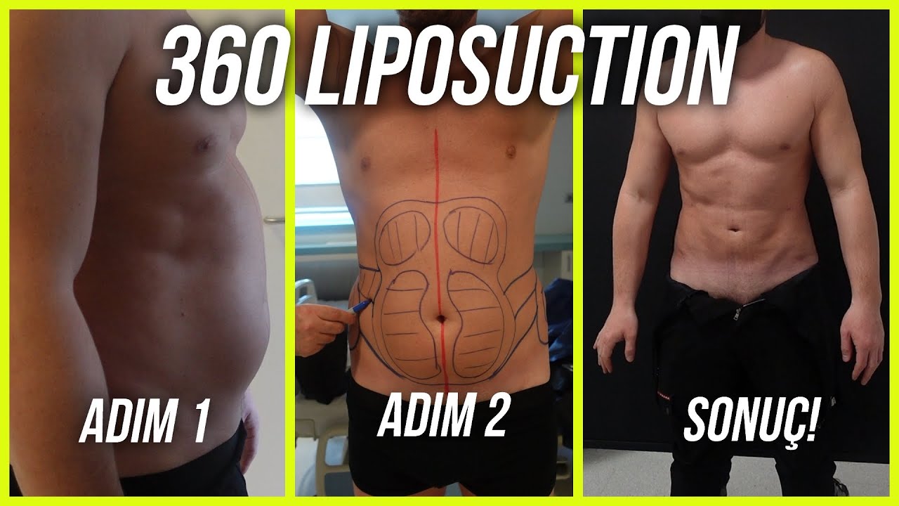 360 derece liposuction  - Öncesi Sonrası ile Tüm Süreç