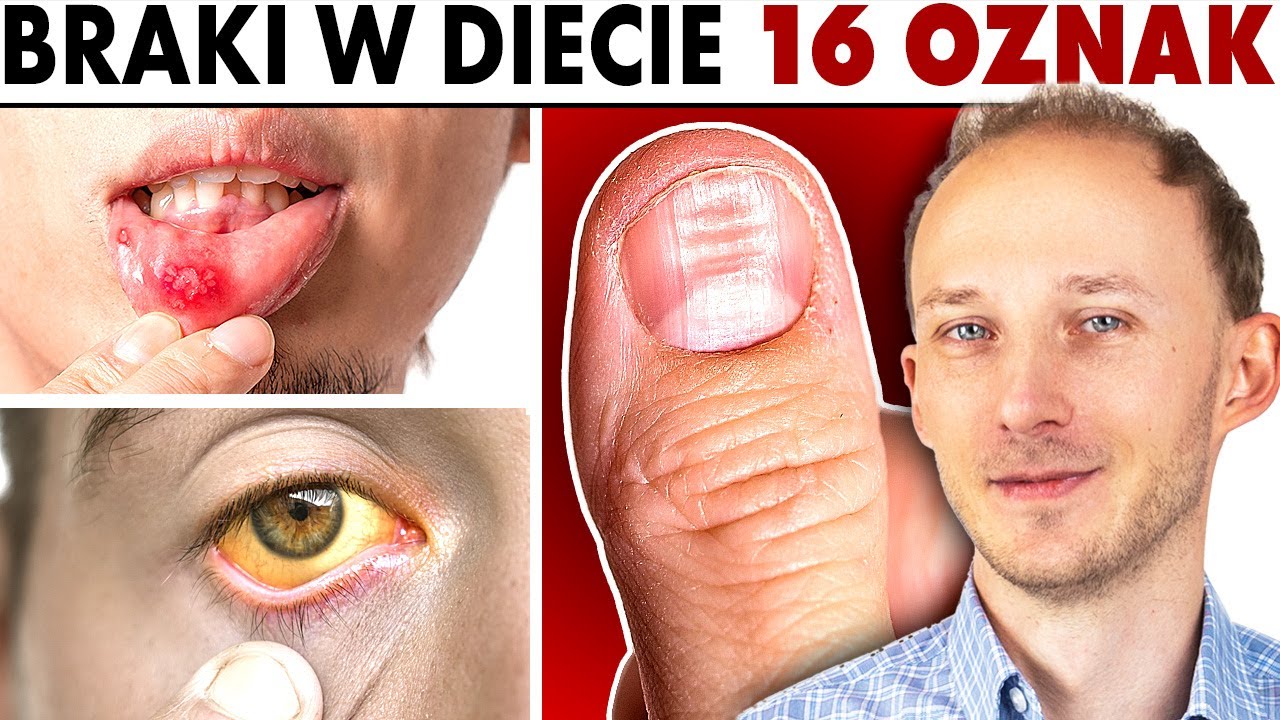 Zdrowie wypisane na ciele: 16 oznak niedoborów w diecie | Dr Bartek Kulczyński