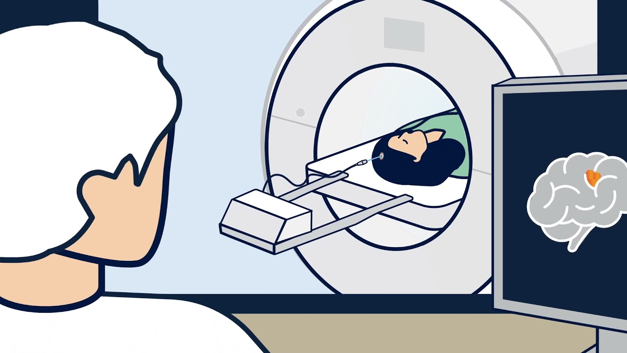 Laser Ablation (LITT) for Brain Tumors