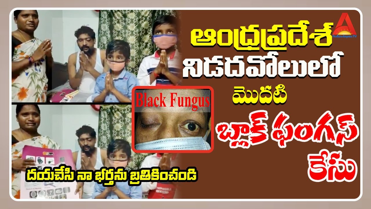 First case of BlackFungus from Nidadavole, West Godavari district, AndhraPradesh || Andhrodayam TV