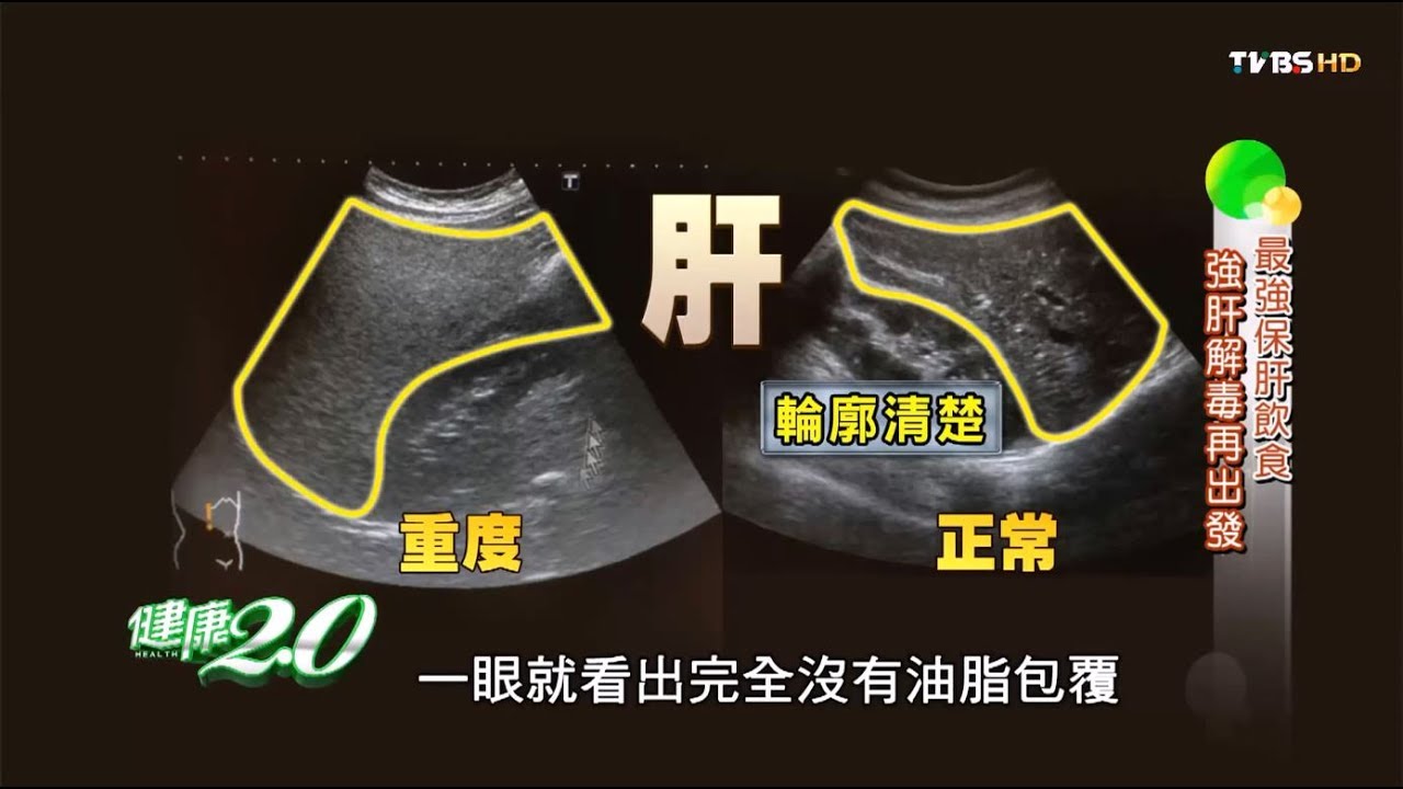 咖啡改善脂肪肝？連醫生都說好的保肝秘方大公開！健康2.0(完整版)