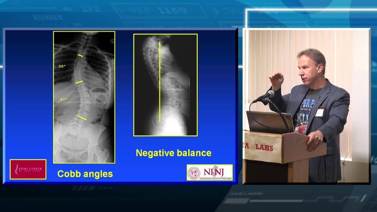 Spinal Deformity: Overview