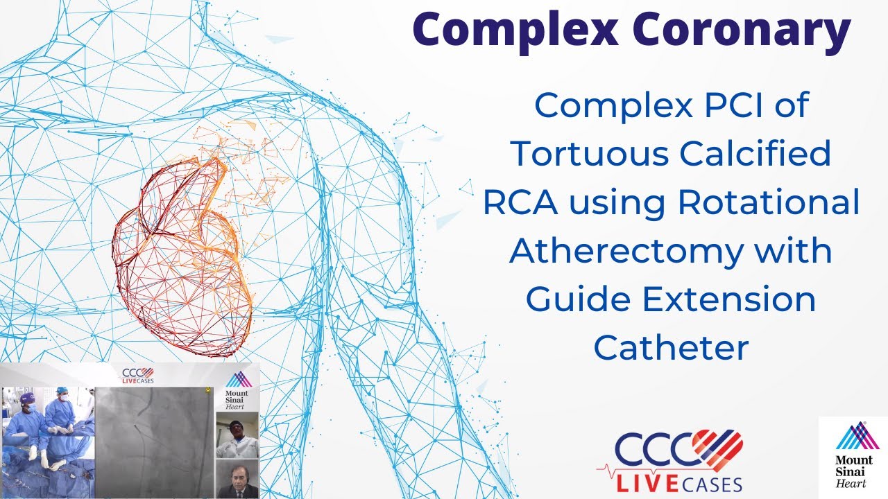 Complex PCI of Tortuous Calcified RCA using Rotational Atherectomy with Guide Extension Catheter