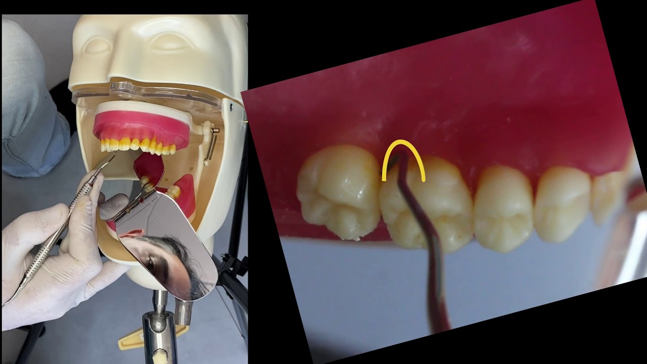Raspagem periodontal supragengival - Primeiro sextante