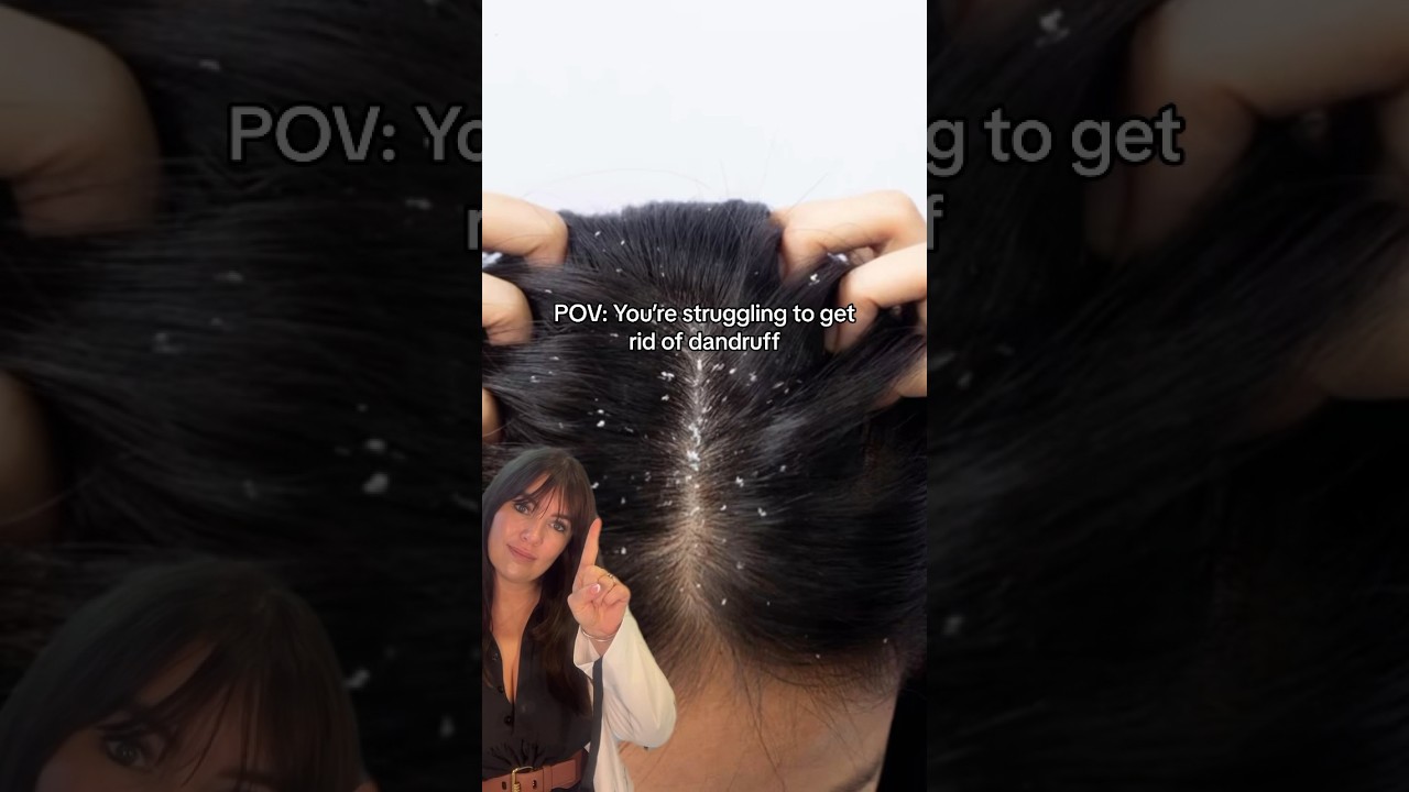 How to get rid of dandruff FAST 👆🏽 #dandruff #dandrufftreatment #dermatologist #hairlosssolution