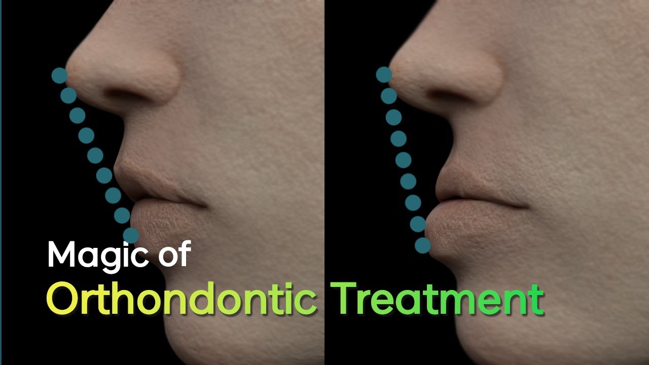Orthodontic treatment, why you need it and how it's done