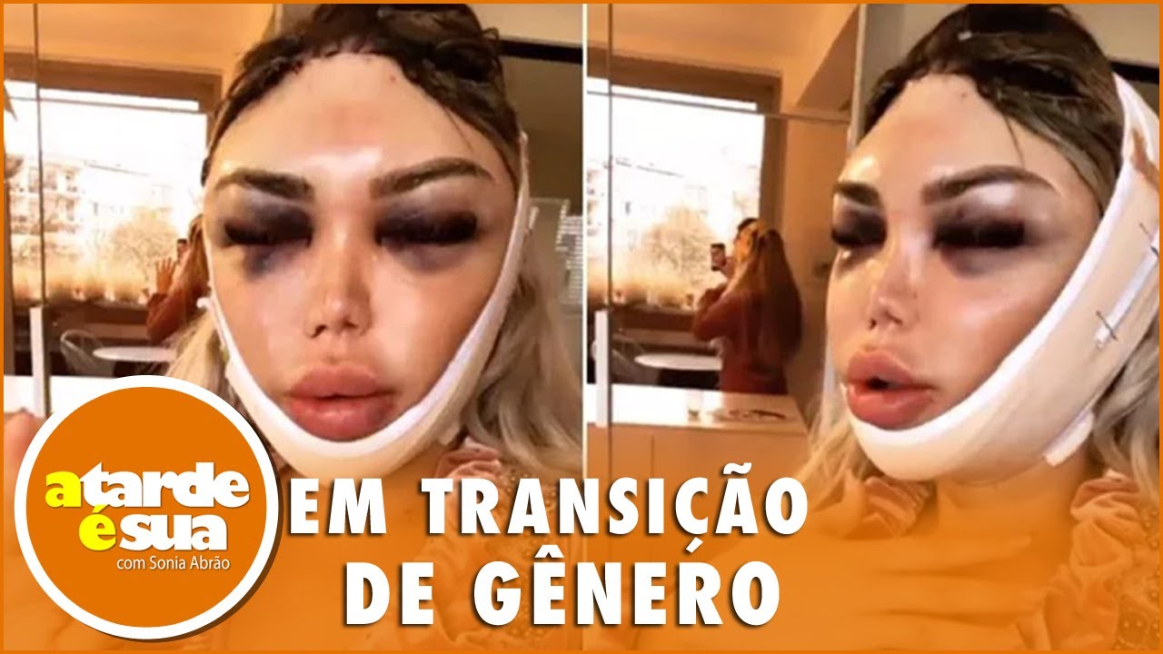 Ex-Ken Humano aparece cheio de hematomas ap&oacute;s fazer feminiliza&ccedil;&atilde;o facial