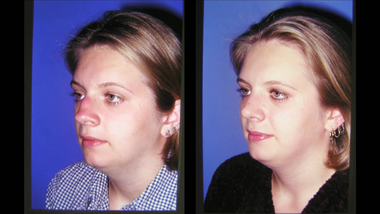 NASHVILLE NASAL (RHINOPLASTY)  PLASTIC SURGERY BEFORE AND AFTER