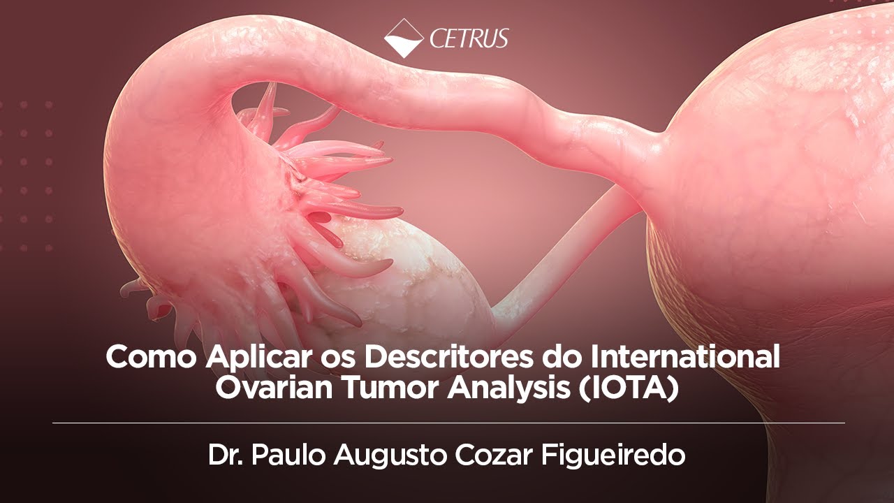 Como Aplicar os Descritores do International Ovarian Tumor Analysis (IOTA) | Dr. Paulo Cozar