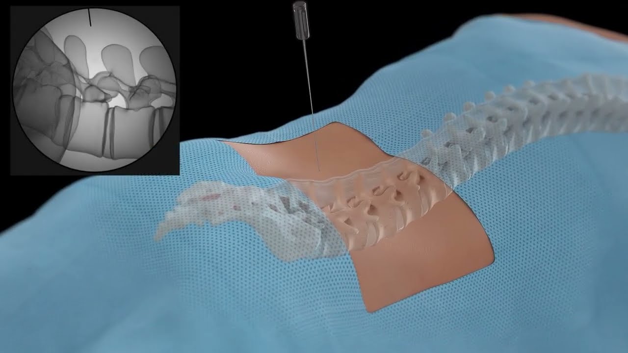 Minuteman® G5 in Action | Spinal Simplicity