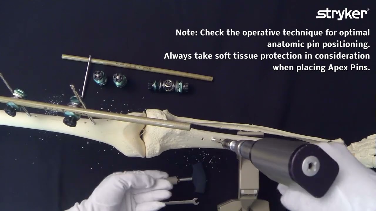 Hoffmann 3 External Fixation System: How to build a Knee Bridging Frame utilizing couplings.