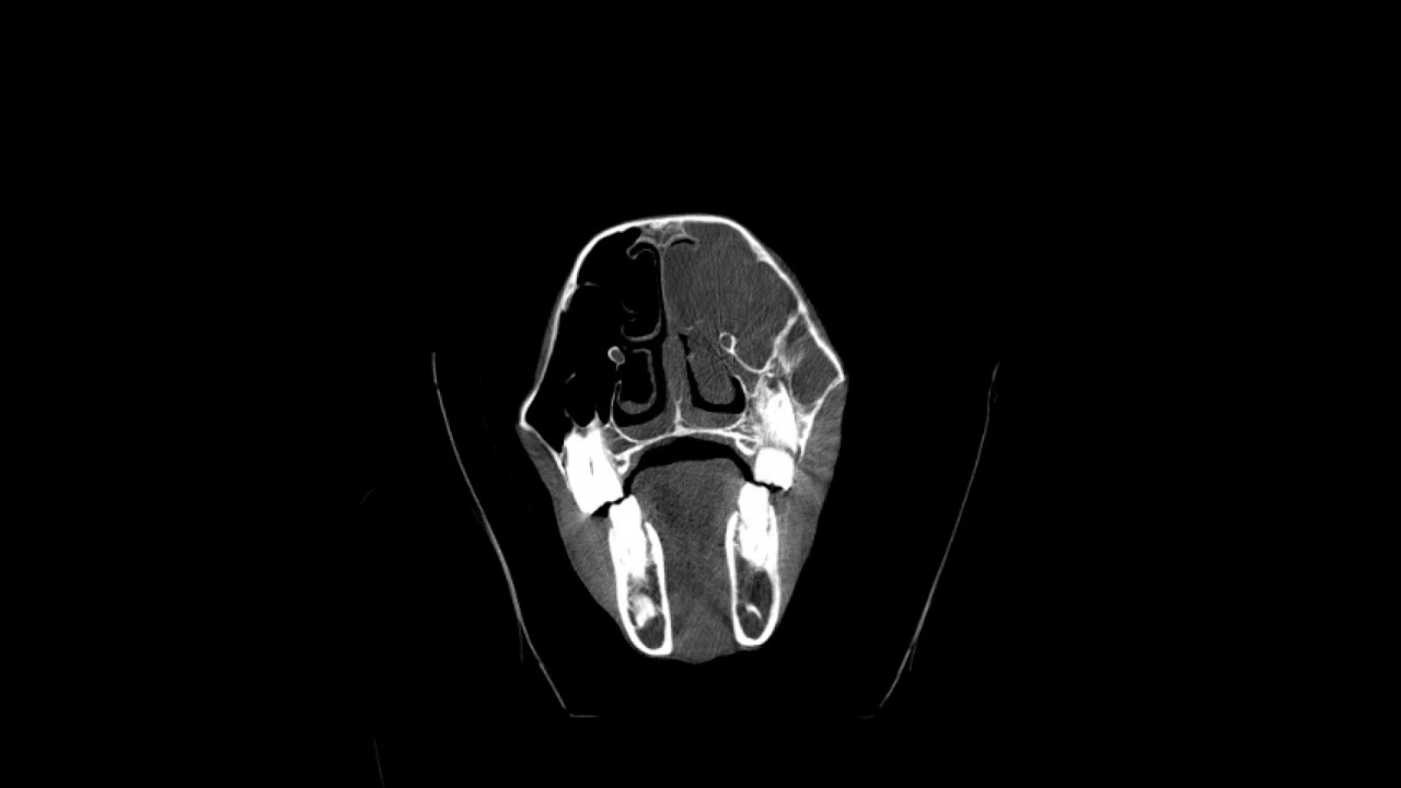 Ethmoid Hematoma