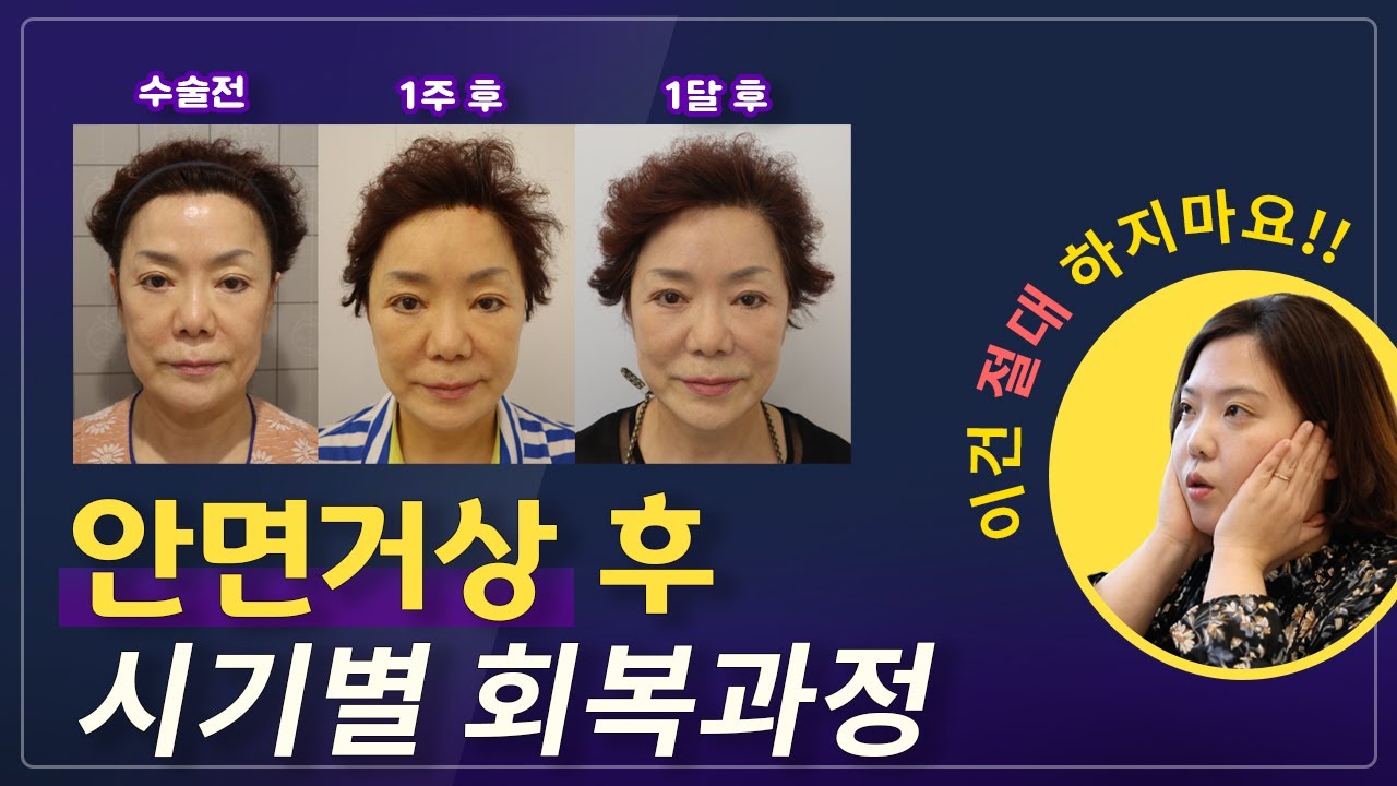 (Eng) 안면거상 후 시기별 회복과정 알려드립니다! The recovery phases of Midface Lifting!