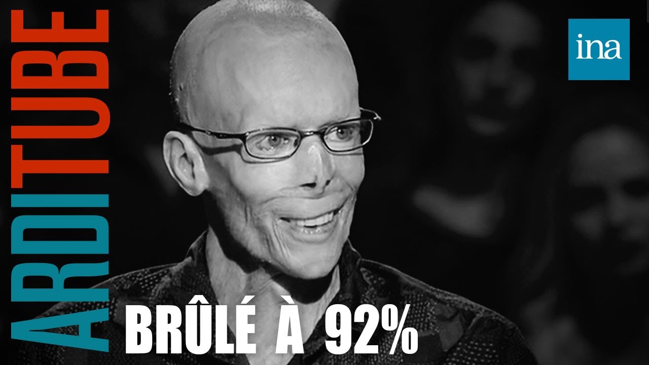 Brûlé à 92% et miraculé, il témoigne chez Thierry Ardisson | INA Arditube