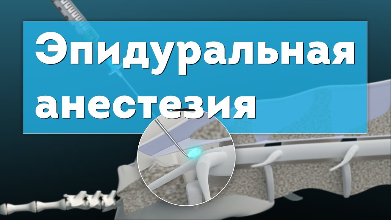 Эпидуральная анестезия. Epidural Anesthesia 3D