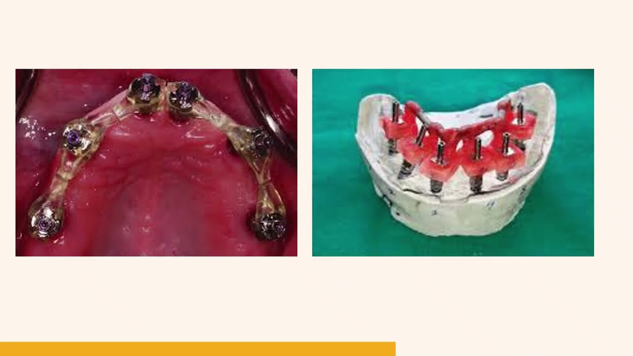 Clinical methods for evaluating implant framework fit