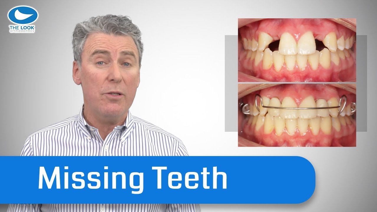 How Orthodontists deal with Missing Teeth - Save yourself years of pain, and cost.
